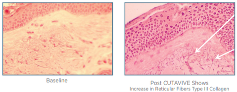 Micro images of skin before and after CUTAVIVE increase in Collagen Bev Sidders Skincare