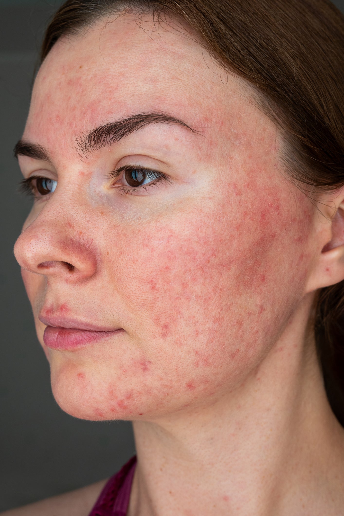 Bev Sidders | Papulopustular rosacea