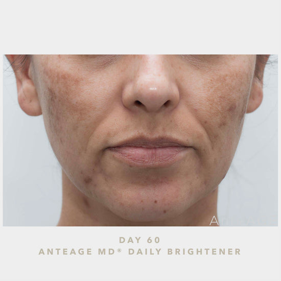 AnteAGE MD Brightener AFTER Photo | Bev Sidders Skincare