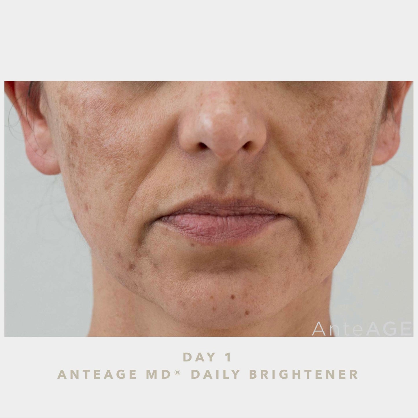 AnteAGE MD Brightener BEFORE Photo | Bev Sidders Skincare