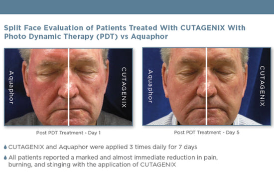 Split Face evaluation of patients treated with CUTAGENIX | Bev Sidders Skincare