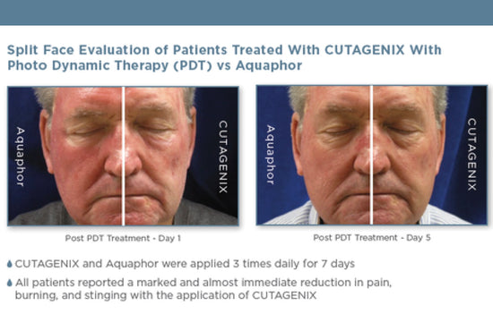 Split Face evaluation of patients treated with CUTAGENIX Bev Sidders Skincare