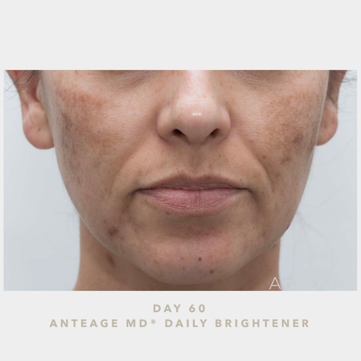 AnteAGE MD Brightener AFTER Photo