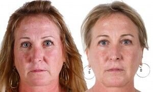 Before and After image showing Anti aging effects from AnteAGE MD Serum | Bev Sidders Skincare