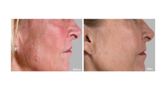 Before and After Results AnteAGE MD Stem Cell and Growth Factors System