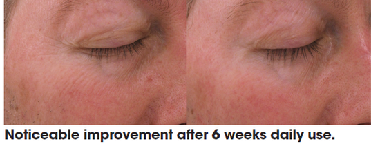 Before and after image (smoker's skin) with noticeable improvement after 6 weeks daily use Bev Sidders Skincare