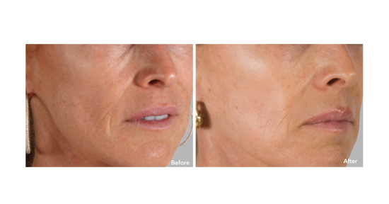 Before and After Results AnteAGE MD Stem Cell and Growth Factors System