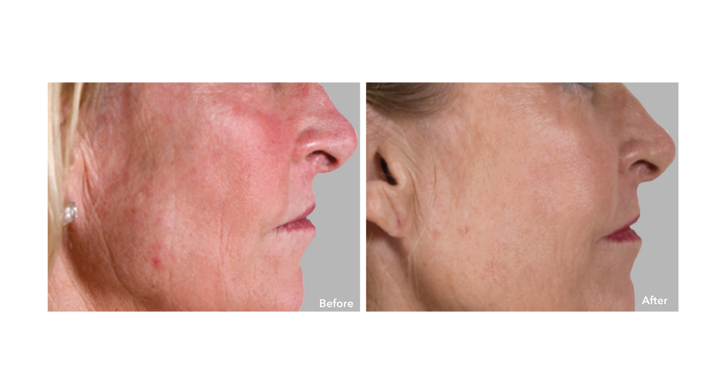 Before and After Results AnteAGE MD Stem Cell and Growth Factors System